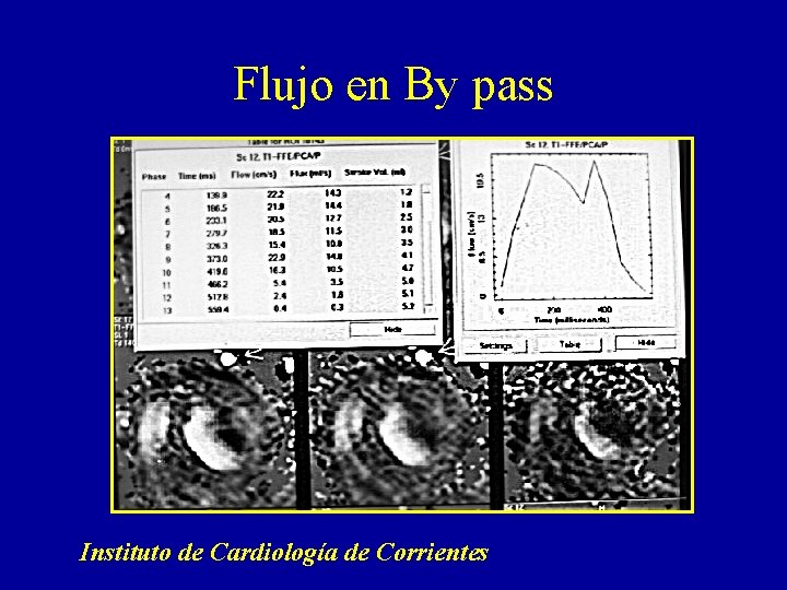 Flujo en By pass Instituto de Cardiología de Corrientes 