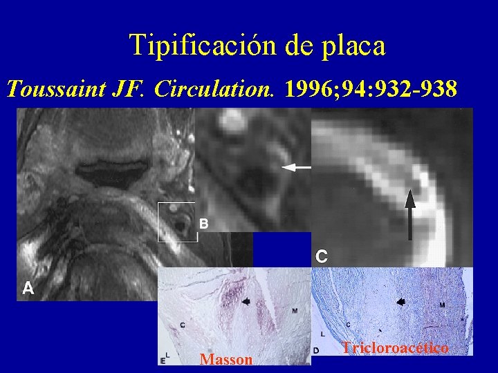 Tipificación de placa Toussaint JF. Circulation. 1996; 94: 932 -938 Masson Tricloroacético 