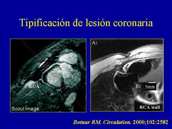 Tipificación de lesión coronaria Botnar RM. Circulation. 2000; 102: 2582 