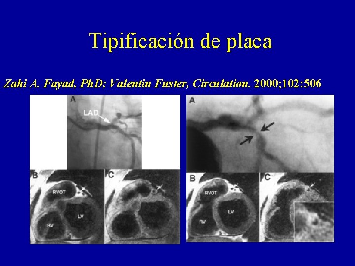 Tipificación de placa Zahi A. Fayad, Ph. D; Valentin Fuster, Circulation. 2000; 102: 506