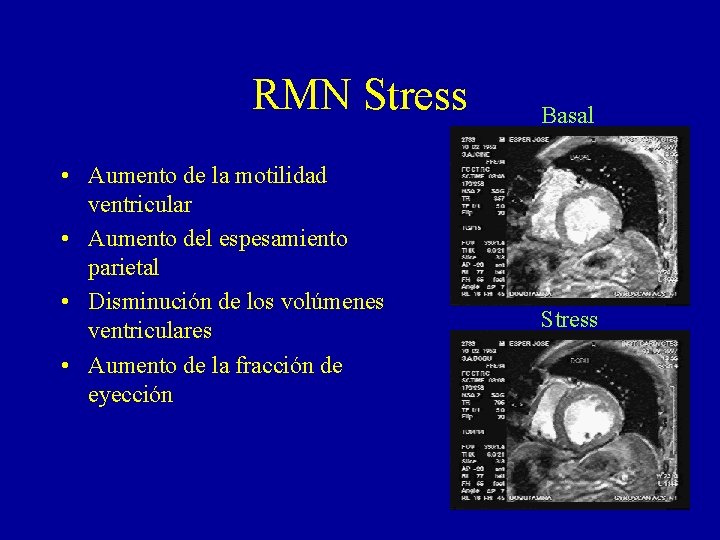 RMN Stress • Aumento de la motilidad ventricular • Aumento del espesamiento parietal •