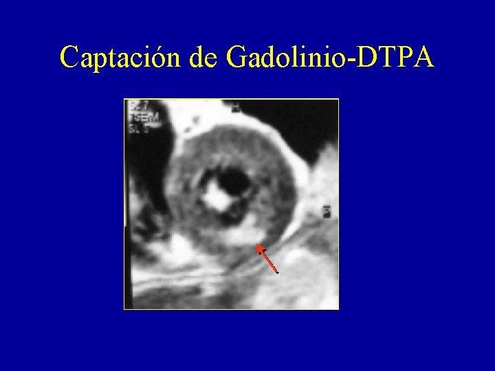 Captación de Gadolinio-DTPA 