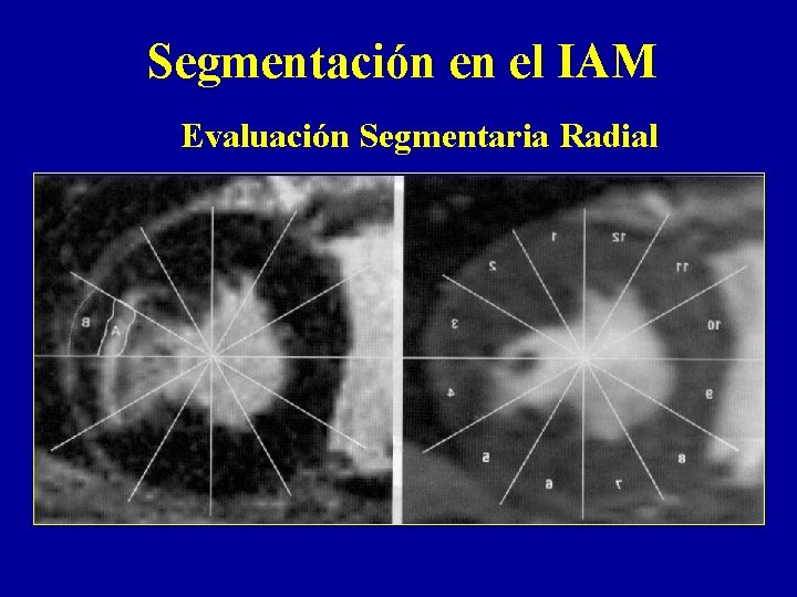 Segmentación en el IAM Evaluación Segmentaria Radial 