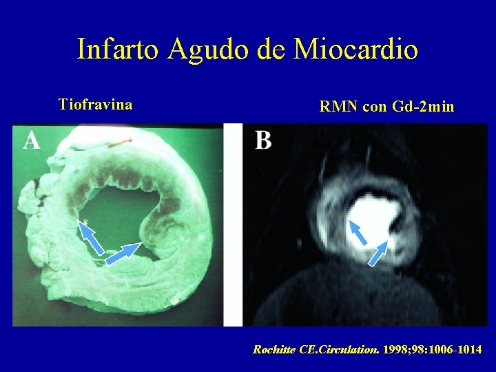 Infarto Agudo de Miocardio Tiofravina RMN con Gd-2 min Rochitte CE. Circulation. 1998; 98: