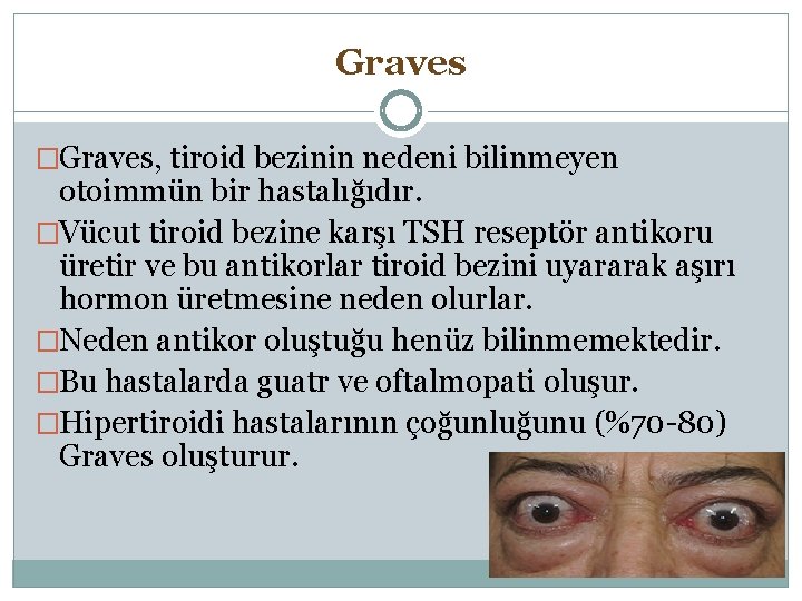 Graves �Graves, tiroid bezinin nedeni bilinmeyen otoimmün bir hastalığıdır. �Vücut tiroid bezine karşı TSH