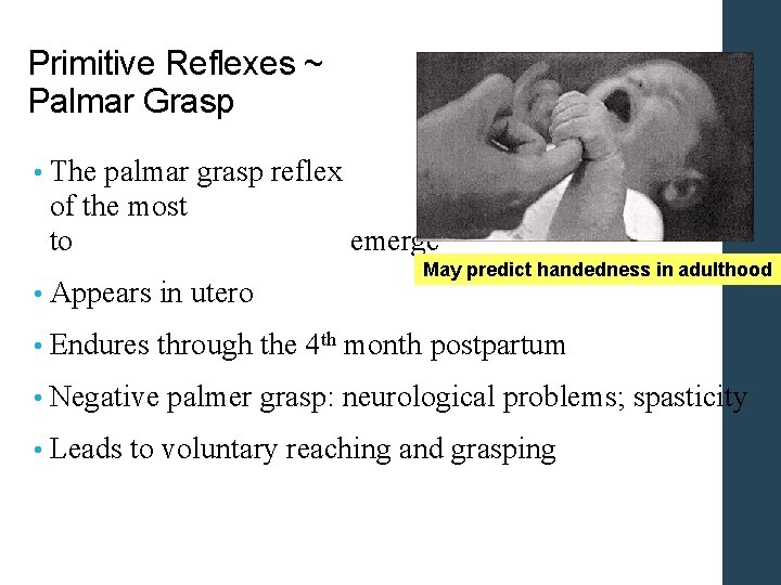 Primitive Reflexes ~ Palmar Grasp • The palmar grasp reflex of the most to