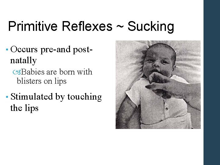 Primitive Reflexes ~ Sucking • Occurs pre-and post- natally Babies are born with blisters Primitive Reflexes ~ Sucking • Occurs pre-and post- natally Babies are born with blisters
