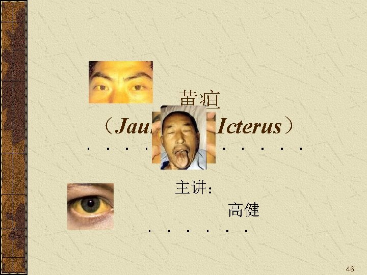 黄疸 （Jaundice / Icterus） 主讲： 高健 46 