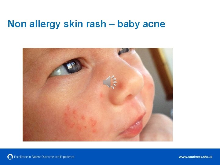 Non allergy skin rash – baby acne 