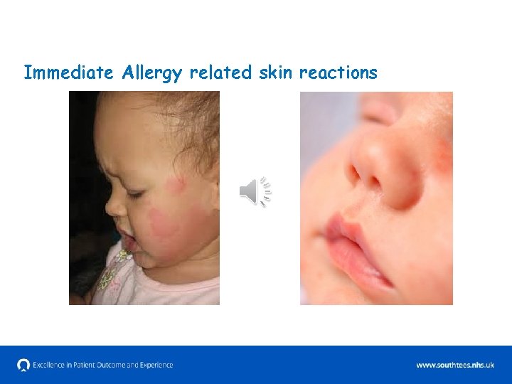 Immediate Allergy related skin reactions 
