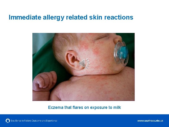 Immediate allergy related skin reactions Eczema that flares on exposure to milk 