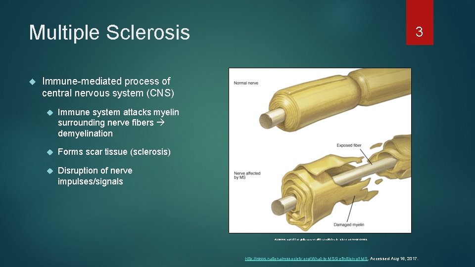 Multiple Sclerosis 3 Immune-mediated process of central nervous system (CNS) Immune system attacks myelin