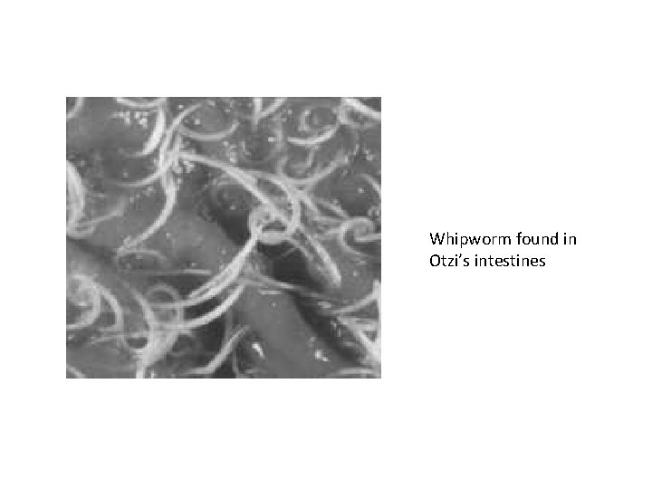 Whipworm found in Otzi’s intestines 