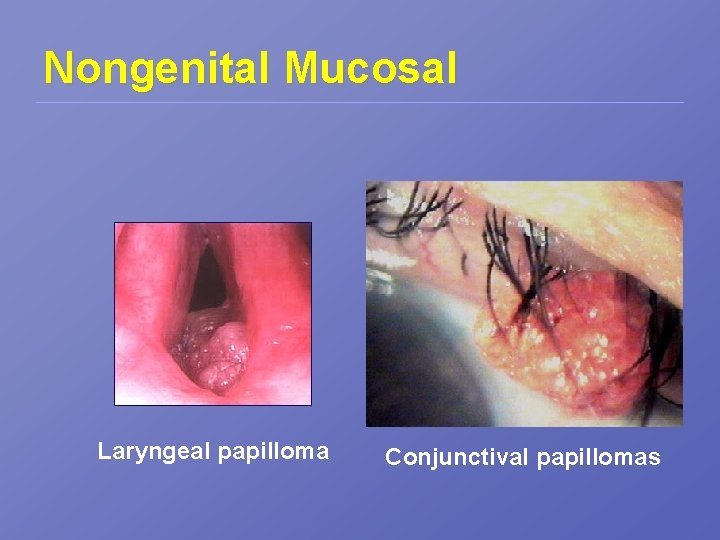 Nongenital Mucosal Laryngeal papilloma Conjunctival papillomas 