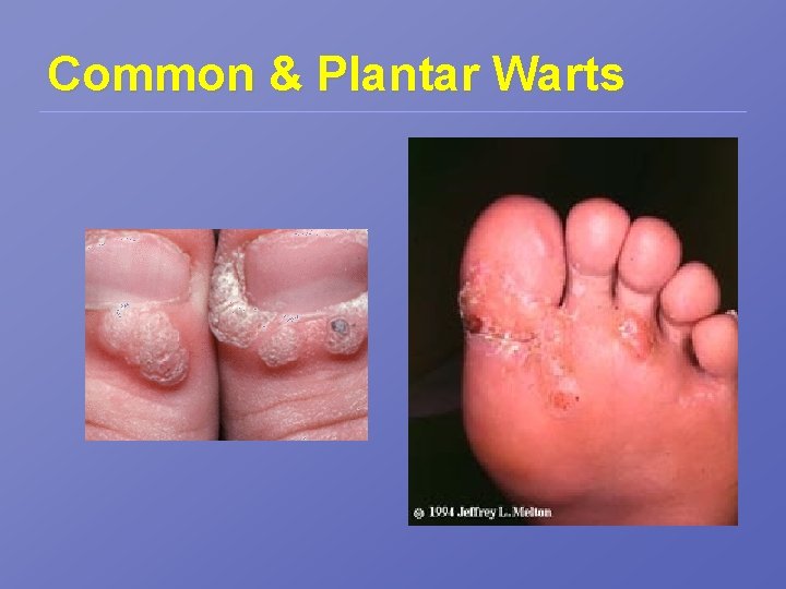 Common & Plantar Warts 