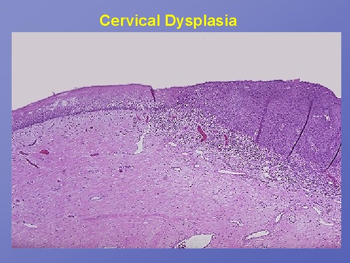 Cervical Dysplasia 