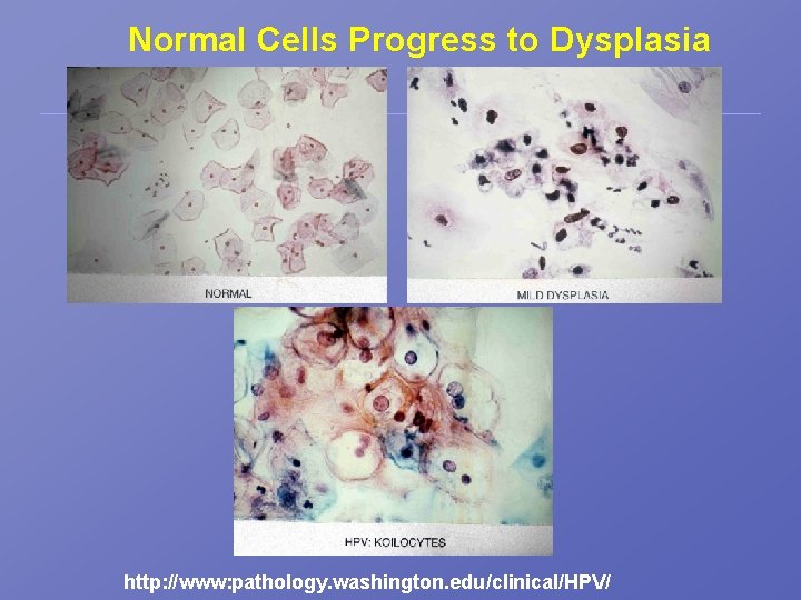 Normal Cells Progress to Dysplasia http: //www: pathology. washington. edu/clinical/HPV/ 