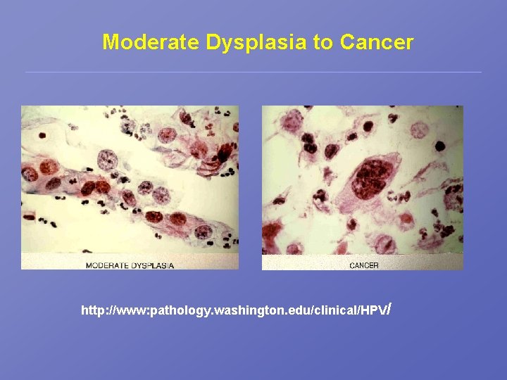 Moderate Dysplasia to Cancer http: //www: pathology. washington. edu/clinical/HPV/ 