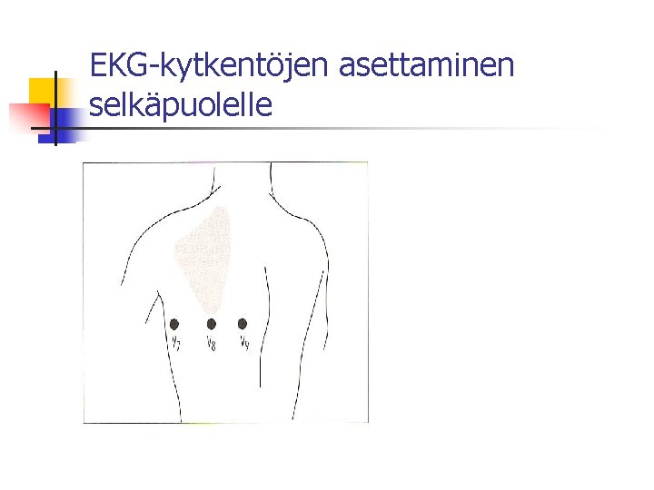 EKG-kytkentöjen asettaminen selkäpuolelle EKG-kytkentöjen asettaminen selkäpuolelle