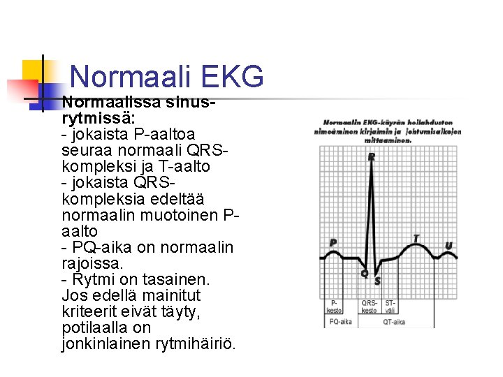 Normaali EKG n Normaalissa sinusrytmissä: - jokaista P-aaltoa seuraa normaali QRSkompleksi ja T-aalto -