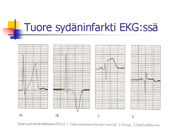 Tuore sydäninfarkti EKG: ssä 