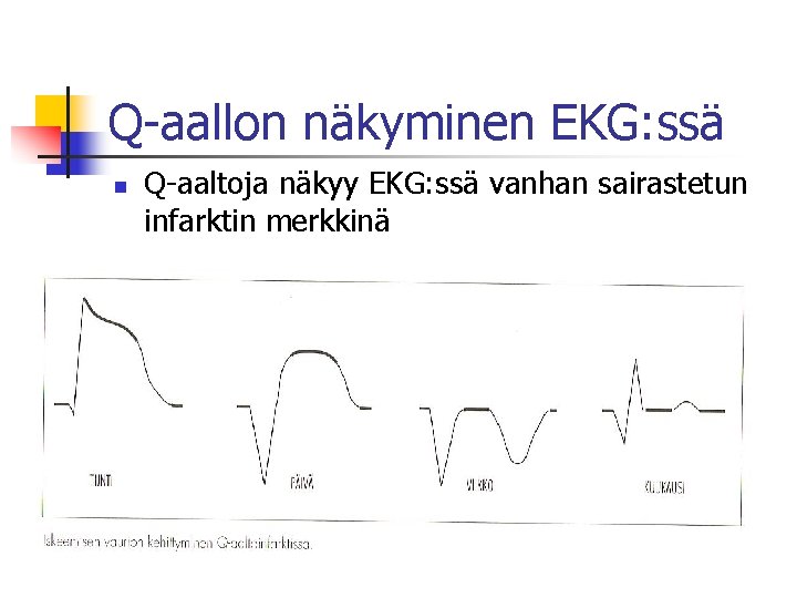 Q-aallon näkyminen EKG: ssä n Q-aaltoja näkyy EKG: ssä vanhan sairastetun infarktin merkkinä 