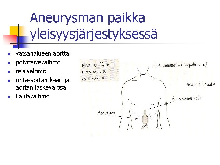 Aneurysman paikka yleisyysjärjestyksessä n n n vatsanalueen aortta polvitaivevaltimo reisivaltimo rinta-aortan kaari ja aortan