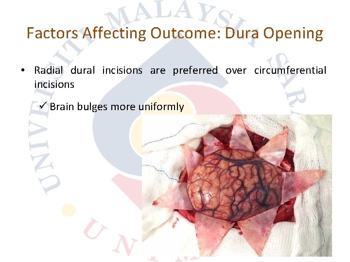 Factors Affecting Outcome: Dura Opening • Radial dural incisions are preferred over circumferential incisions