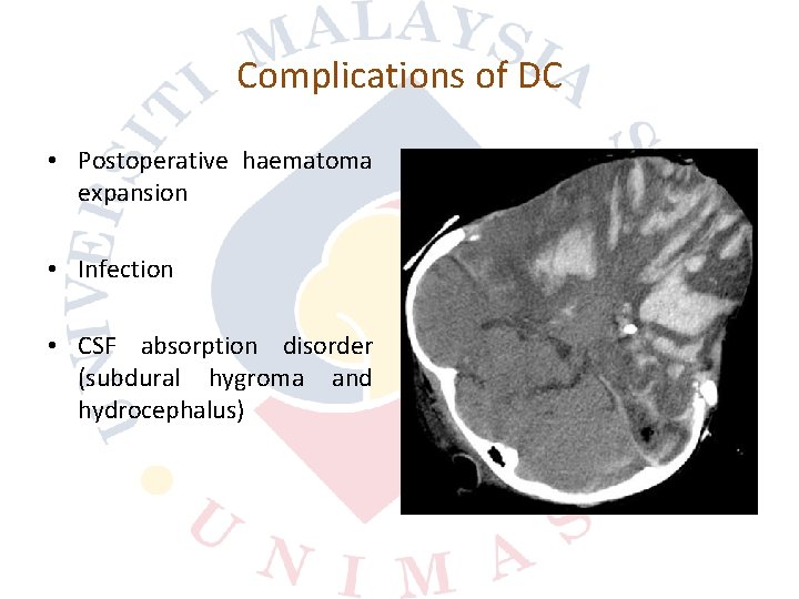 Complications of DC • Postoperative haematoma expansion • Infection • CSF absorption disorder (subdural