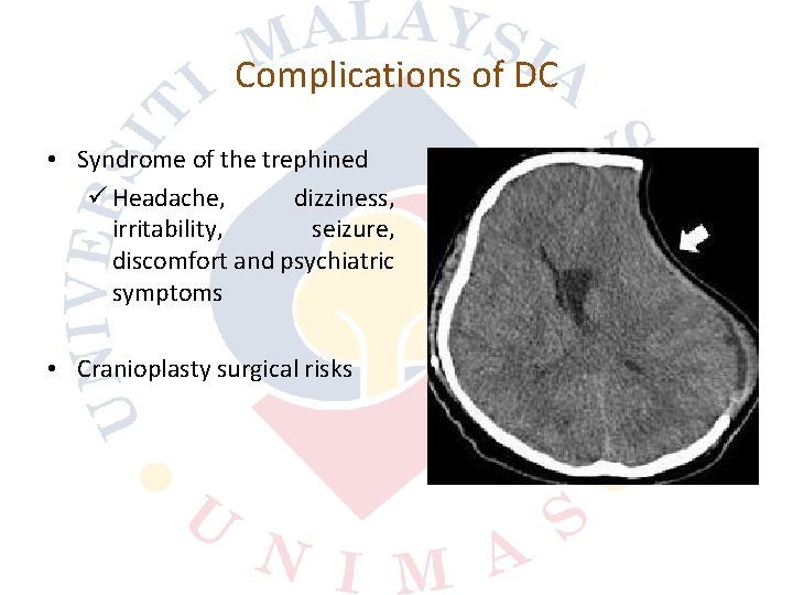 Complications of DC • Syndrome of the trephined ü Headache, dizziness, irritability, seizure, discomfort