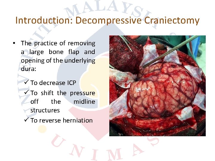 Introduction: Decompressive Craniectomy • The practice of removing a large bone flap and opening