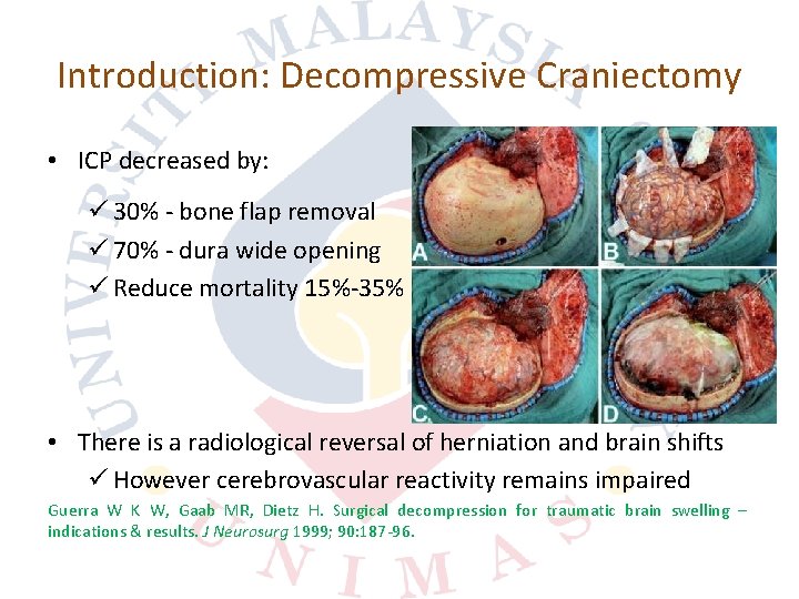 Introduction: Decompressive Craniectomy • ICP decreased by: ü 30% bone flap removal ü 70%