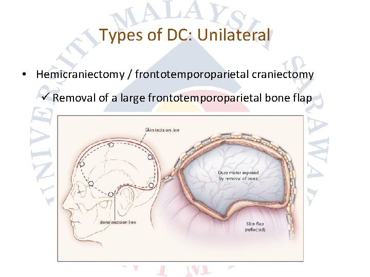 Types of DC: Unilateral • Hemicraniectomy / frontotemporoparietal craniectomy ü Removal of a large