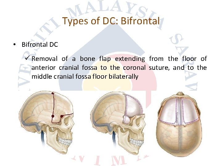 Types of DC: Bifrontal • Bifrontal DC ü Removal of a bone flap extending