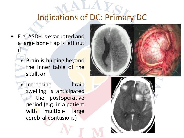 Indications of DC: Primary DC • E. g. ASDH is evacuated and a large