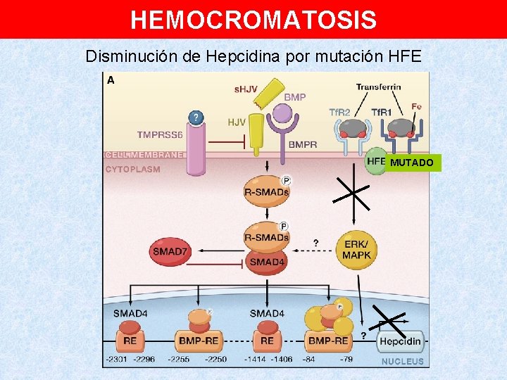 HEMOCROMATOSIS Disminución de Hepcidina por mutación HFE MUTADO 