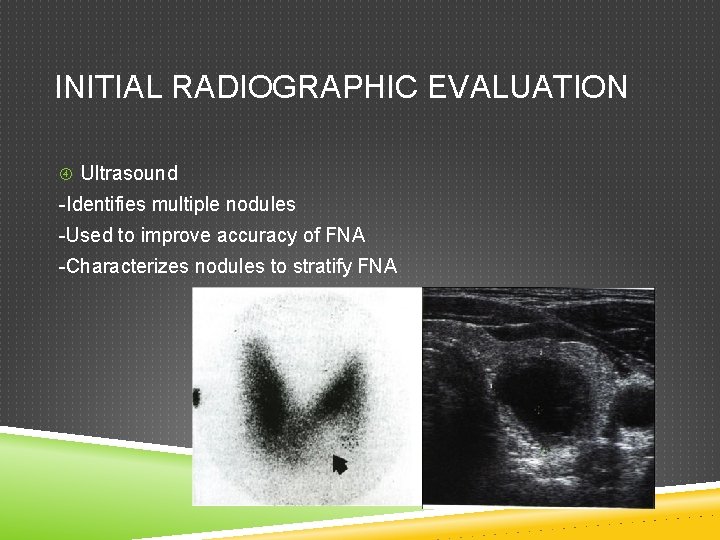 INITIAL RADIOGRAPHIC EVALUATION Ultrasound -Identifies multiple nodules -Used to improve accuracy of FNA -Characterizes