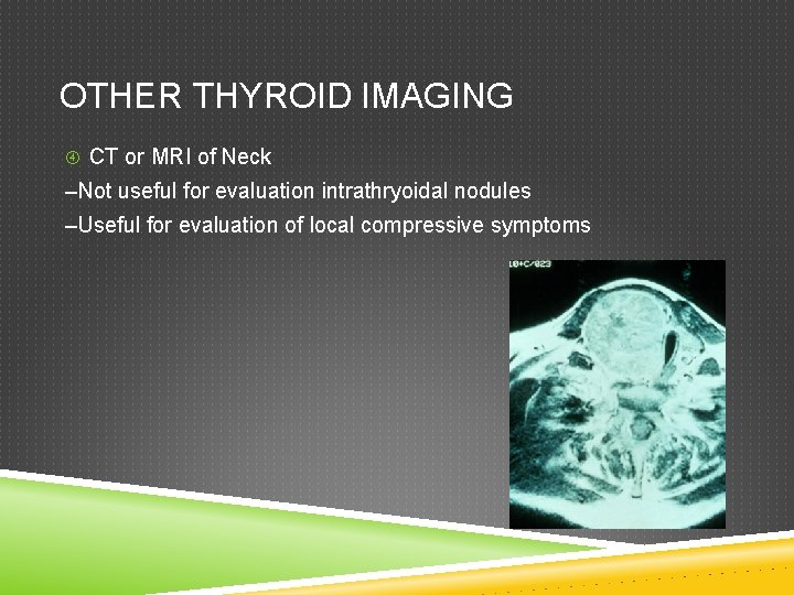 OTHER THYROID IMAGING CT or MRI of Neck –Not useful for evaluation intrathryoidal nodules