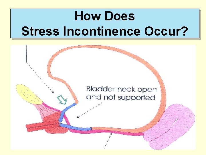 How Does Stress Incontinence Occur? How Does Stress Incontinence Occur?