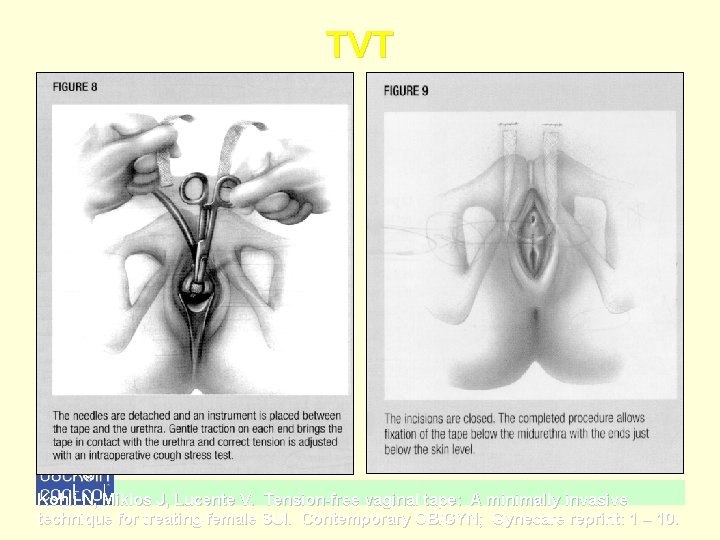 TVT Kohli N, Miklos J, Lucente V. Tension-free vaginal tape: A minimally invasive technique TVT Kohli N, Miklos J, Lucente V. Tension-free vaginal tape: A minimally invasive technique