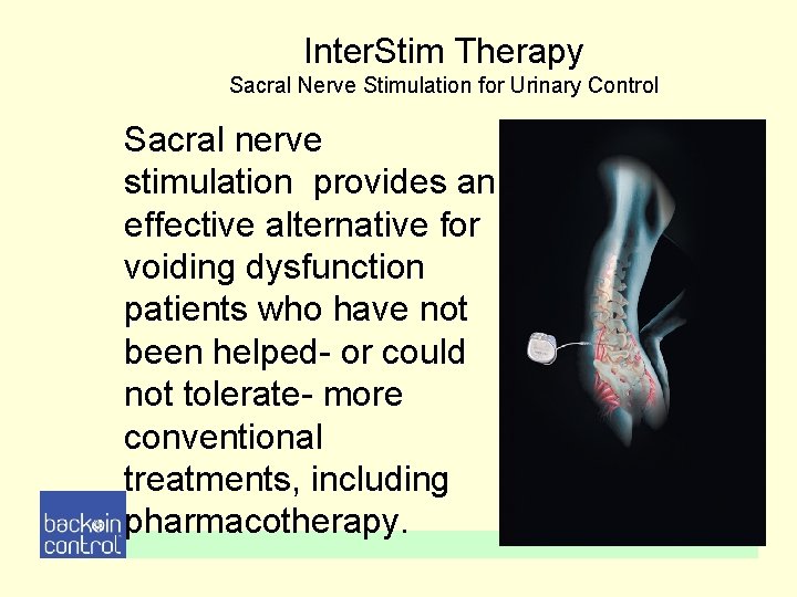 Inter. Stim Therapy Sacral Nerve Stimulation for Urinary Control Sacral nerve stimulation provides an Inter. Stim Therapy Sacral Nerve Stimulation for Urinary Control Sacral nerve stimulation provides an