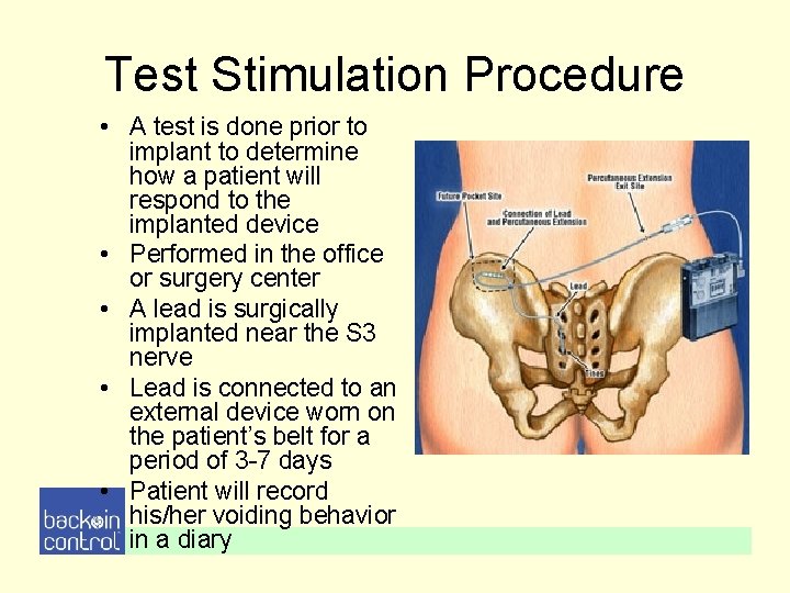 Test Stimulation Procedure • A test is done prior to implant to determine how Test Stimulation Procedure • A test is done prior to implant to determine how