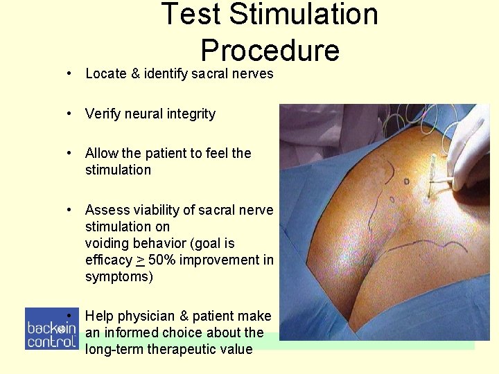 Test Stimulation Procedure • Locate & identify sacral nerves • Verify neural integrity • Test Stimulation Procedure • Locate & identify sacral nerves • Verify neural integrity •