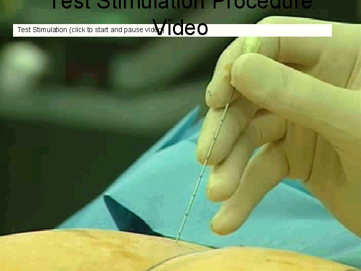 Test Stimulation Procedure Video Test Stimulation (click to start and pause video) Test Stimulation Procedure Video Test Stimulation (click to start and pause video)