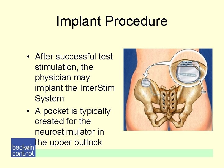Implant Procedure • After successful test stimulation, the physician may implant the Inter. Stim Implant Procedure • After successful test stimulation, the physician may implant the Inter. Stim