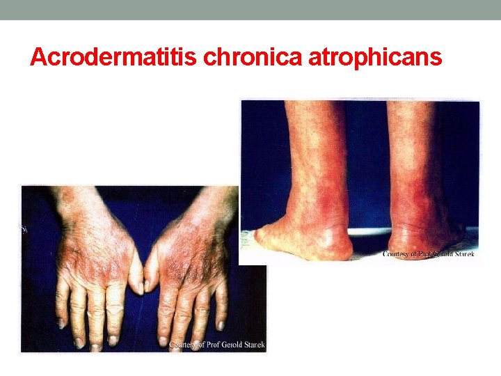 Acrodermatitis chronica atrophicans 