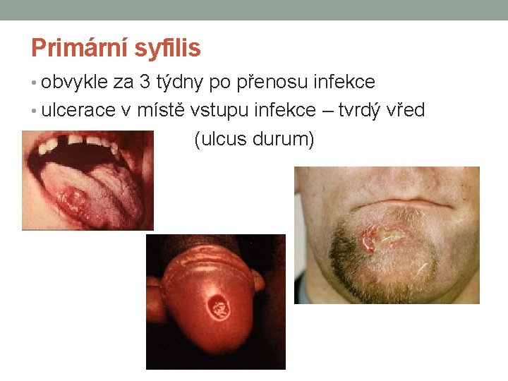 Primární syfilis • obvykle za 3 týdny po přenosu infekce • ulcerace v místě