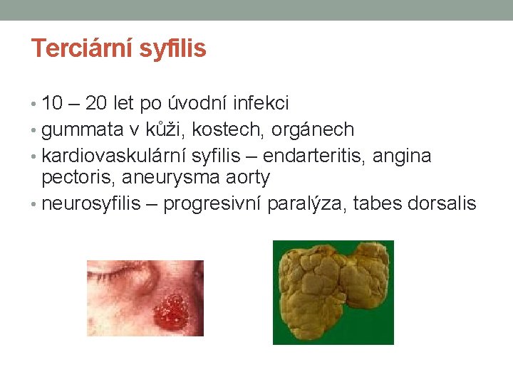 Terciární syfilis • 10 – 20 let po úvodní infekci • gummata v kůži,