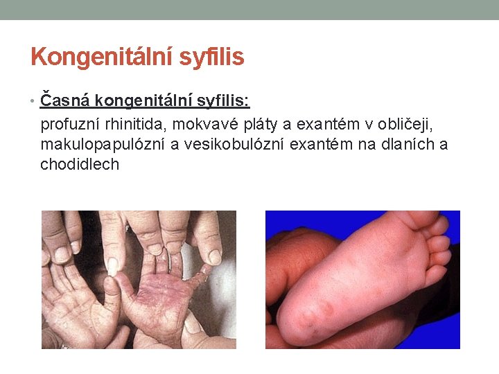 Kongenitální syfilis • Časná kongenitální syfilis: profuzní rhinitida, mokvavé pláty a exantém v obličeji,