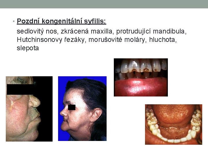  • Pozdní kongenitální syfilis: sedlovitý nos, zkrácená maxilla, protrudující mandibula, Hutchinsonovy řezáky, morušovité